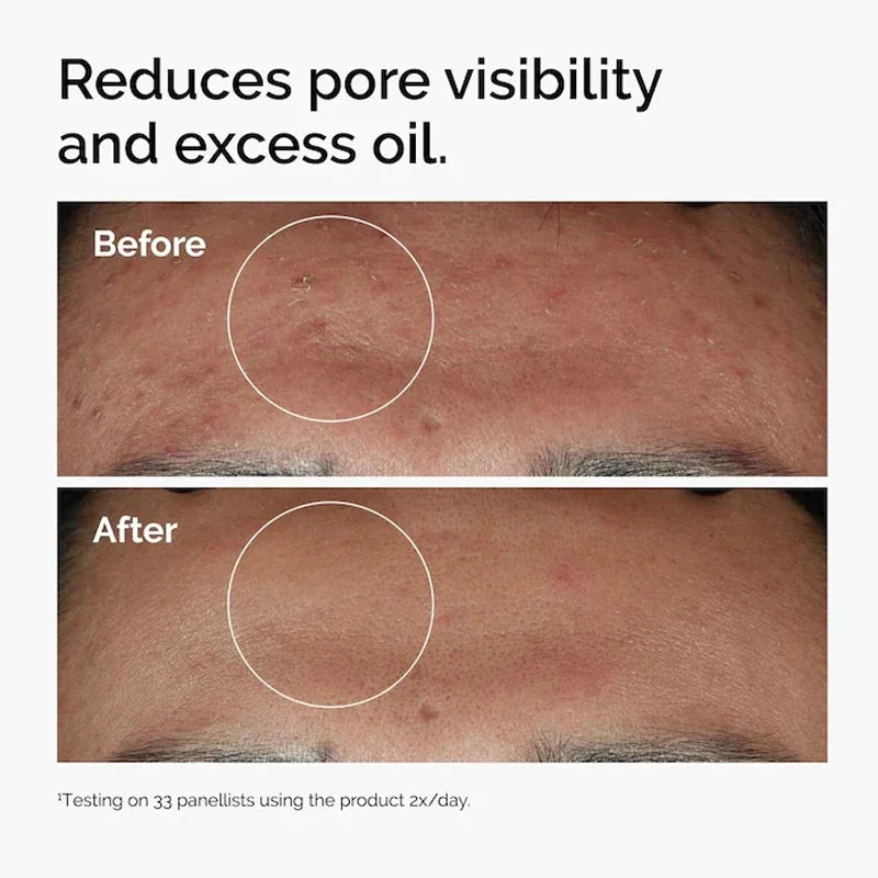 The Ordinary Facial Serum "Niacinamide 10% + Zinc 1% 30ml"